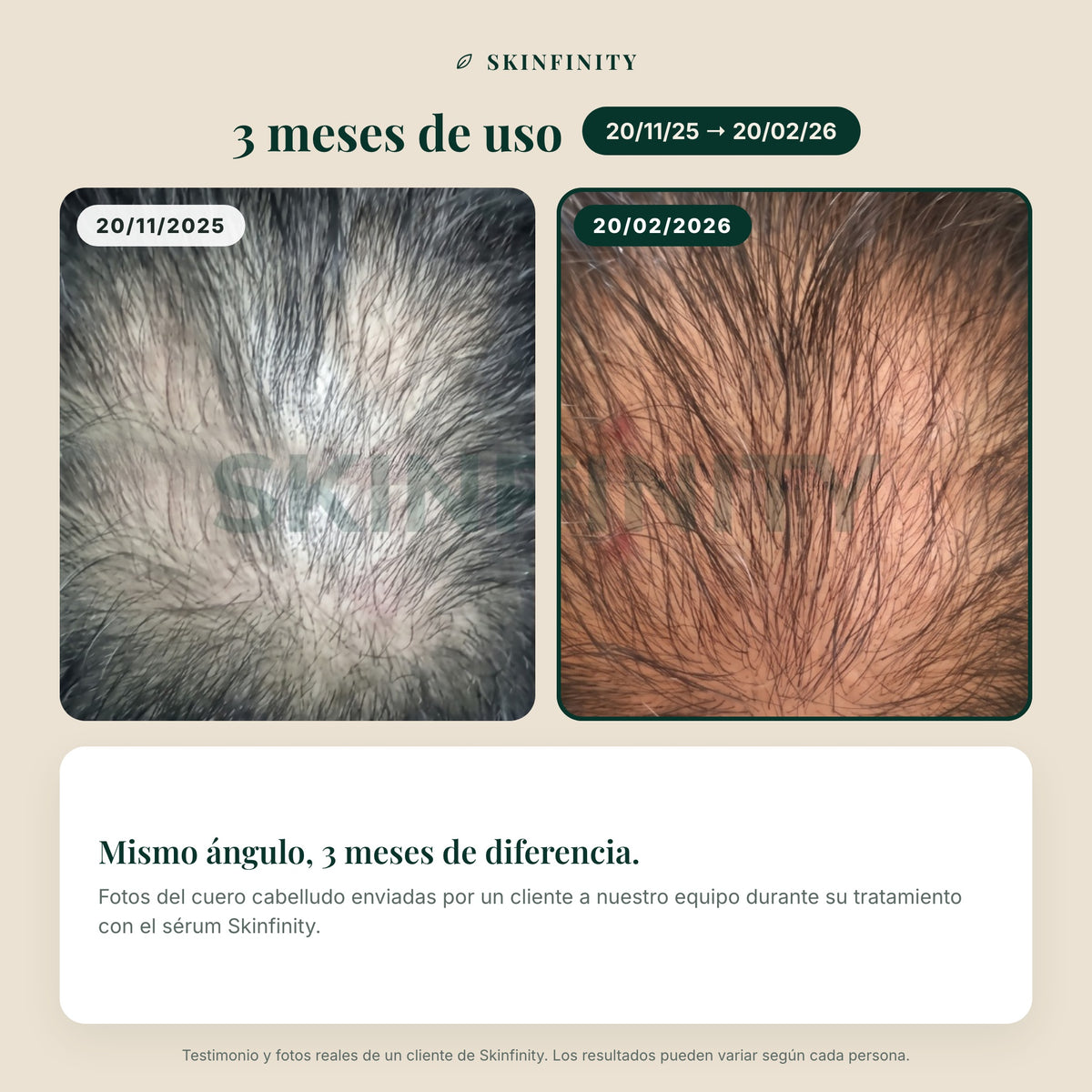 Serum Skinfinity - Fórmula avanzada de Saw Palmetto y Jojoba para crecimiento capilar