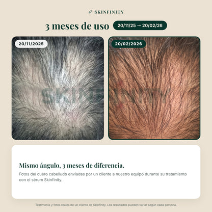 Serum Skinfinity - Fórmula avanzada de Saw Palmetto y Jojoba para crecimiento capilar